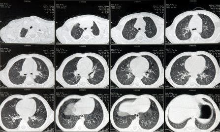 Normal lung on CT