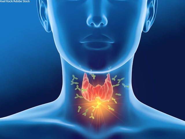 Patients with benign thyroid tumors resected with a transoral endoscopic thyroidectomy vestibular approach have less complications vs those treated with a standard surgical approach.