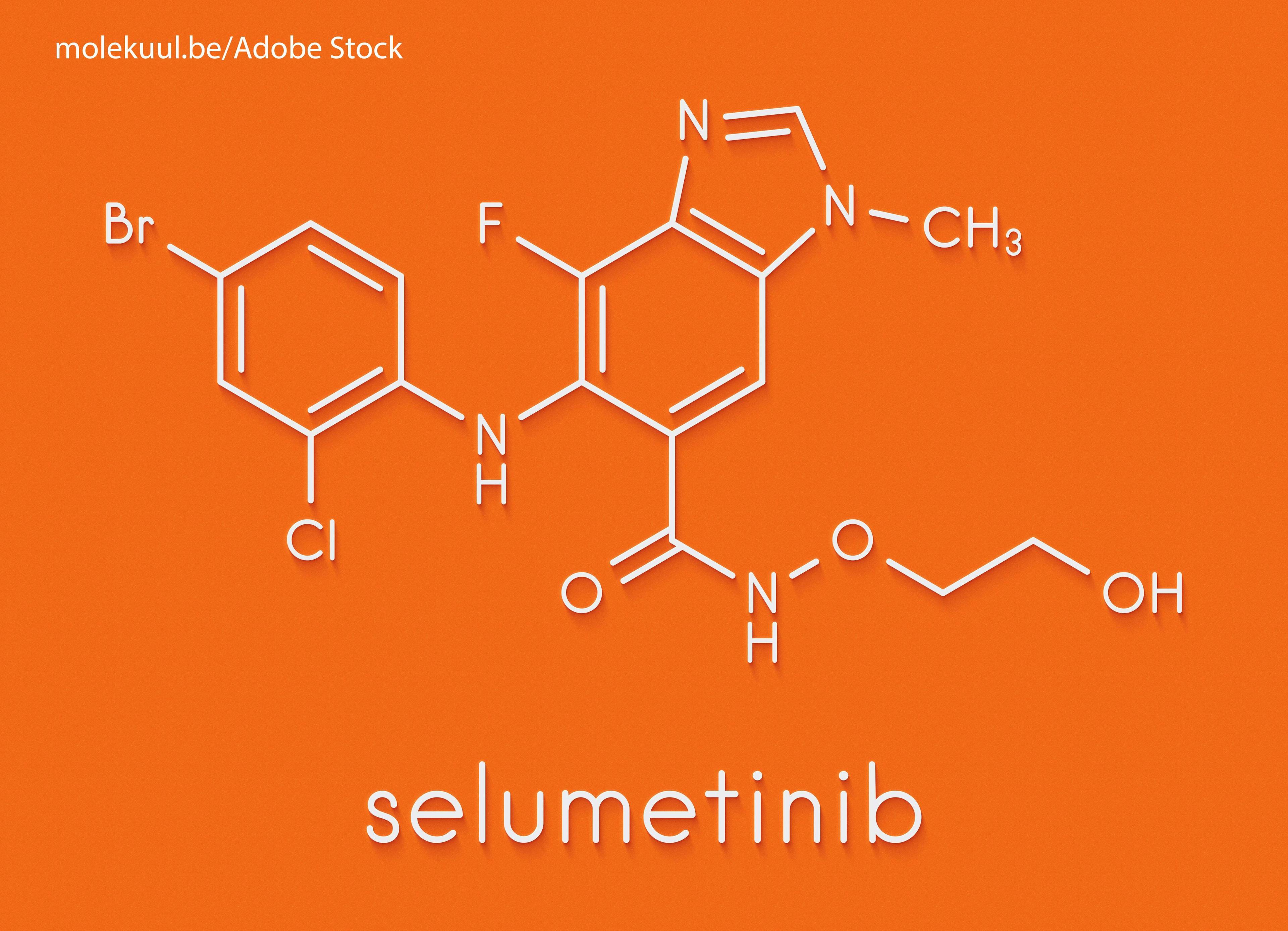 Selumetinib Clinically Improves NF1-Associated Neurofibromas