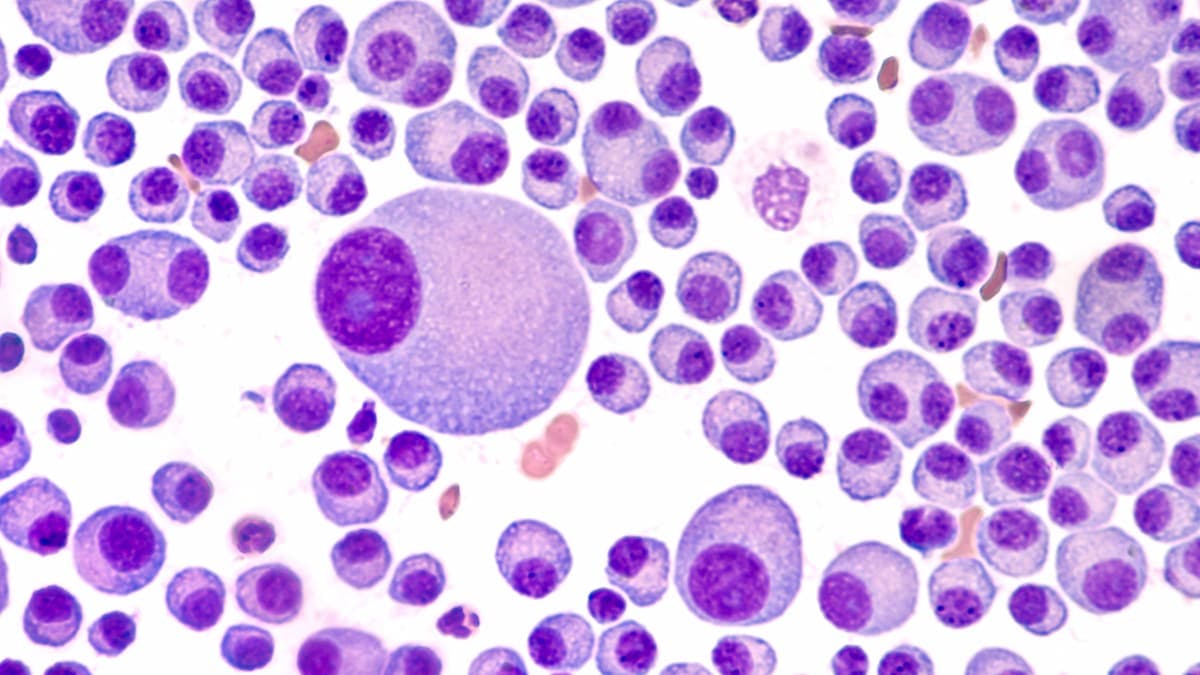 Among patients with extramedullary multiple myeloma, a regimen consisting of daratumumab plus dexamethasone, cyclophosphamide, etoposide, and cisplatin yielded a complete remission rate of 35.5% and an overall response rate of 67.7%.