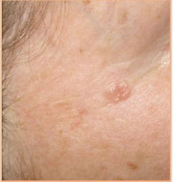 Why Are Non-Melanoma Skin Cancers Untreated in the Elderly 