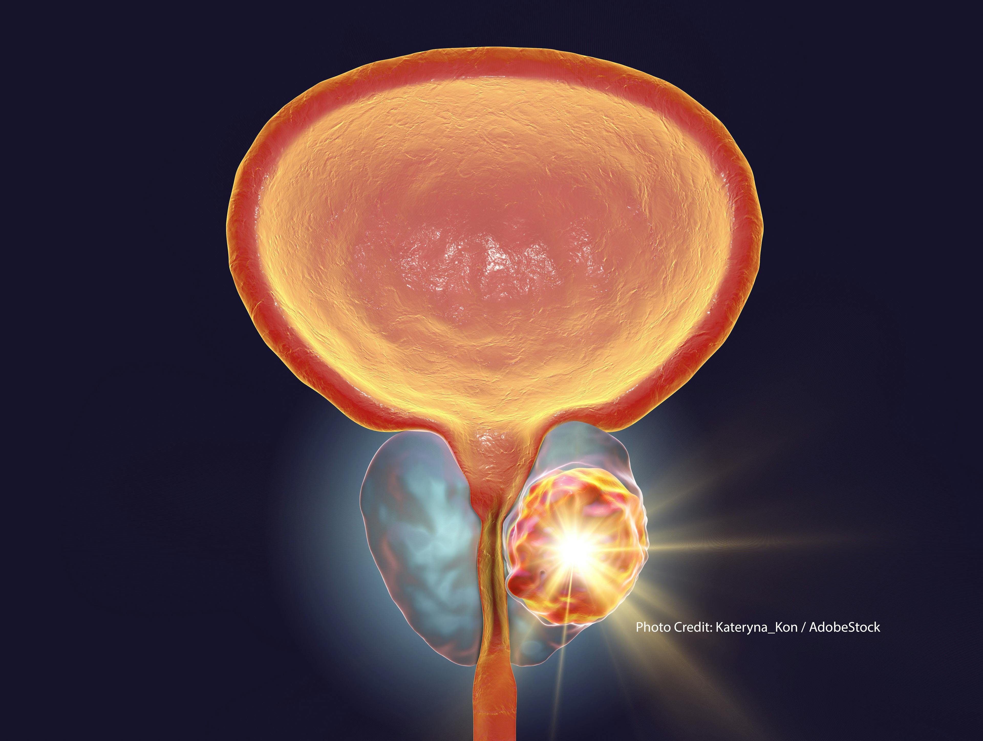 New Expert Guidance on EBRT in Men with Early-Stage Prostate Cancer