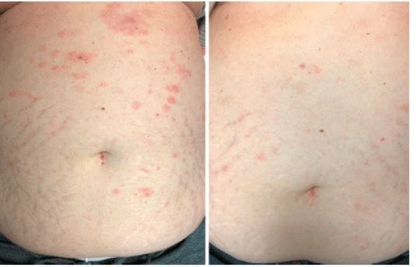 Progressive Red-to-Violaceous Papules and Plaques on the Neck and Abdominal Skin of a 70-Year-Old Woman