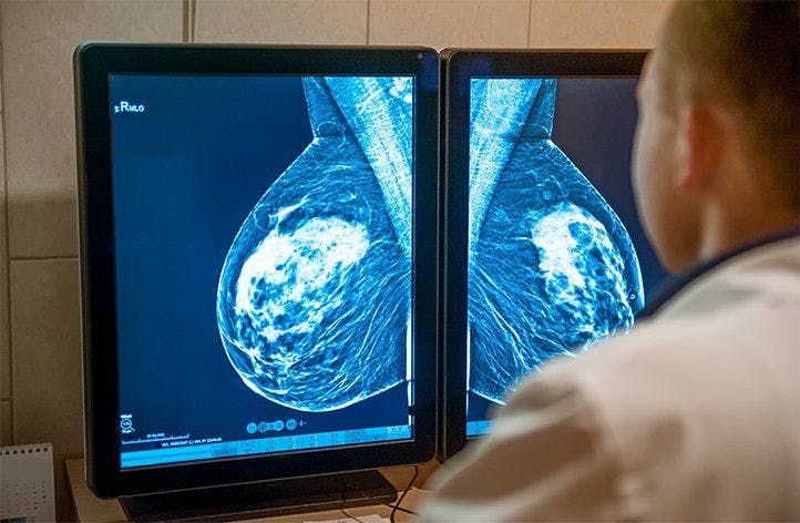 How Various Breast Cancer Screening Guidelines Compare