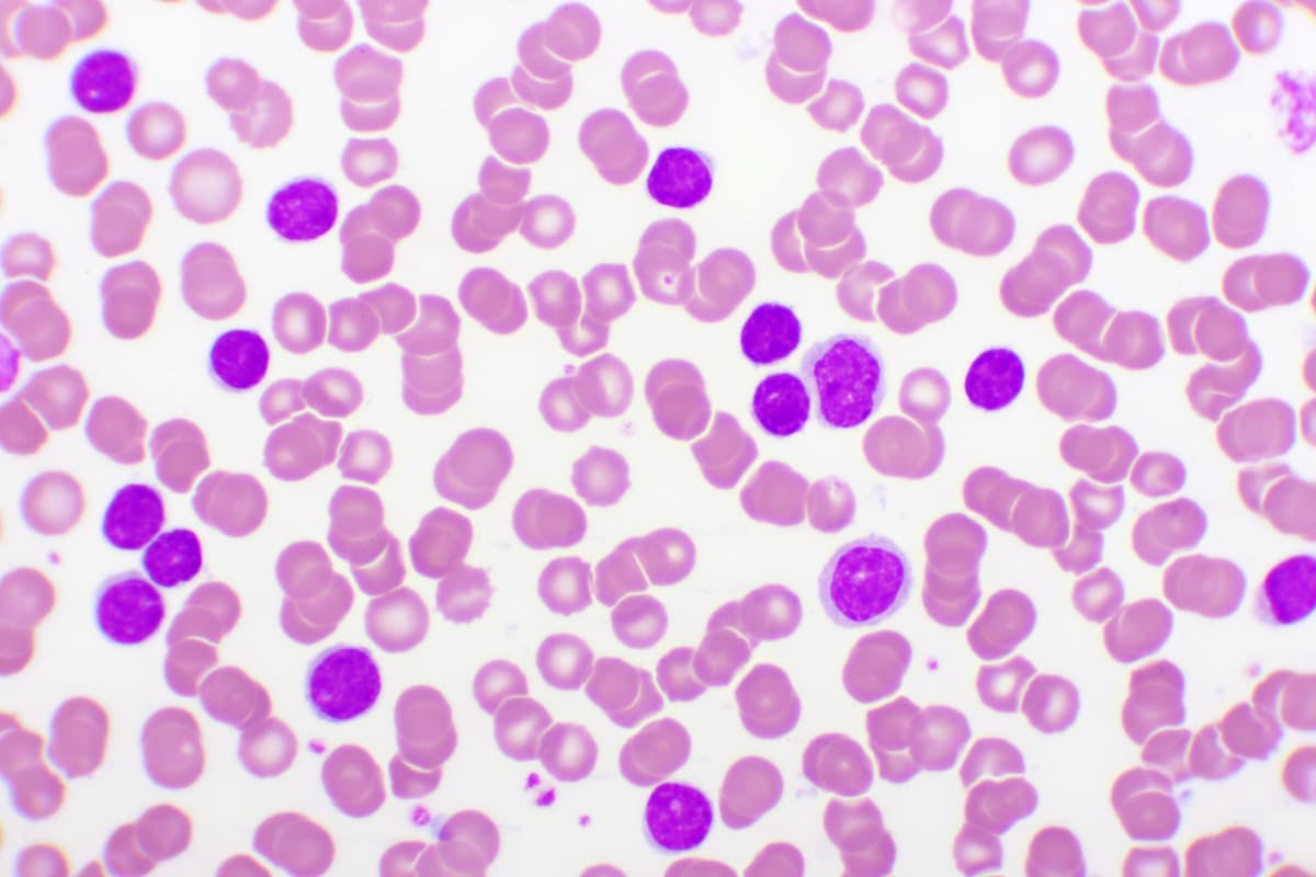 Adult patients with chronic lymphocytic leukemia in the European Union can now receive treatment with acalabrutinib tablets.