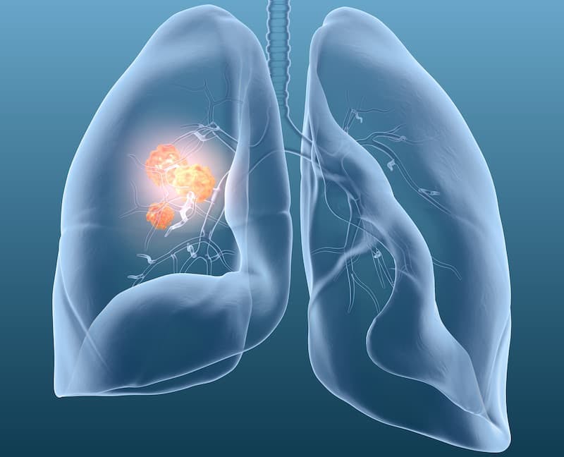 Updated Trial Findings Indicate Neratinib Shows Potential in EGFR Exon 18–Mutant NSCLC