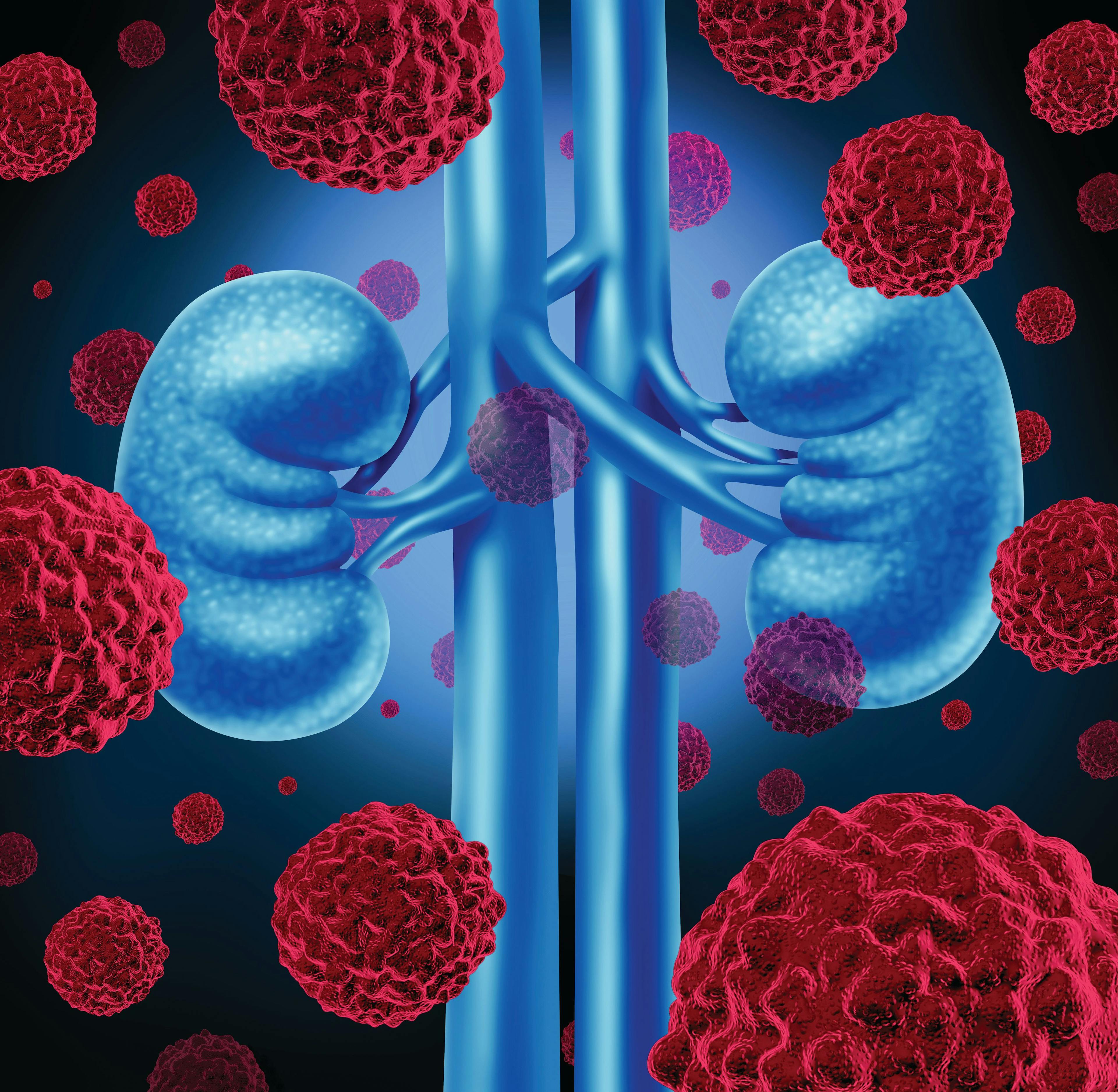 Navigating an Optimal Treatment Course for Advanced Kidney Cancer