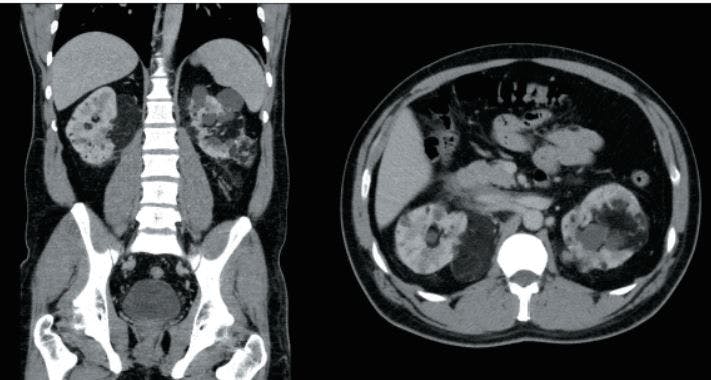 Bilateral, Multifocal Renal Masses in a 35-Year-Old Man With a History of Tuberous Sclerosis Complex