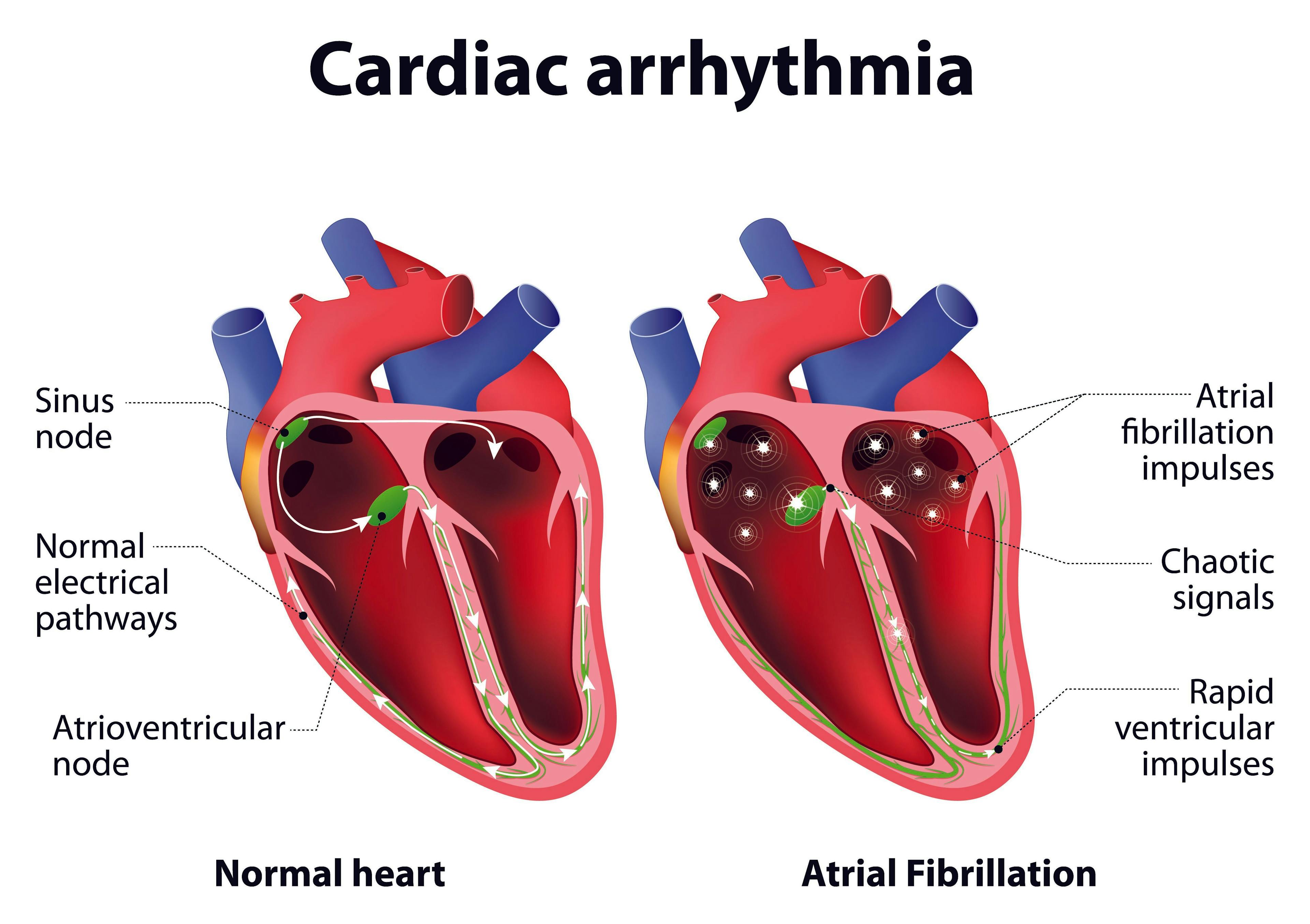 Atrial Fibrillation: Considerations for the Use of BTK Inhibitors