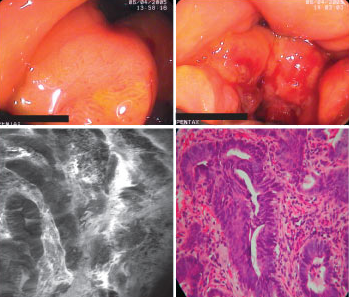 Advanced adenocarcinoma of the stomach; source: Dr. Ralf Kiesslich