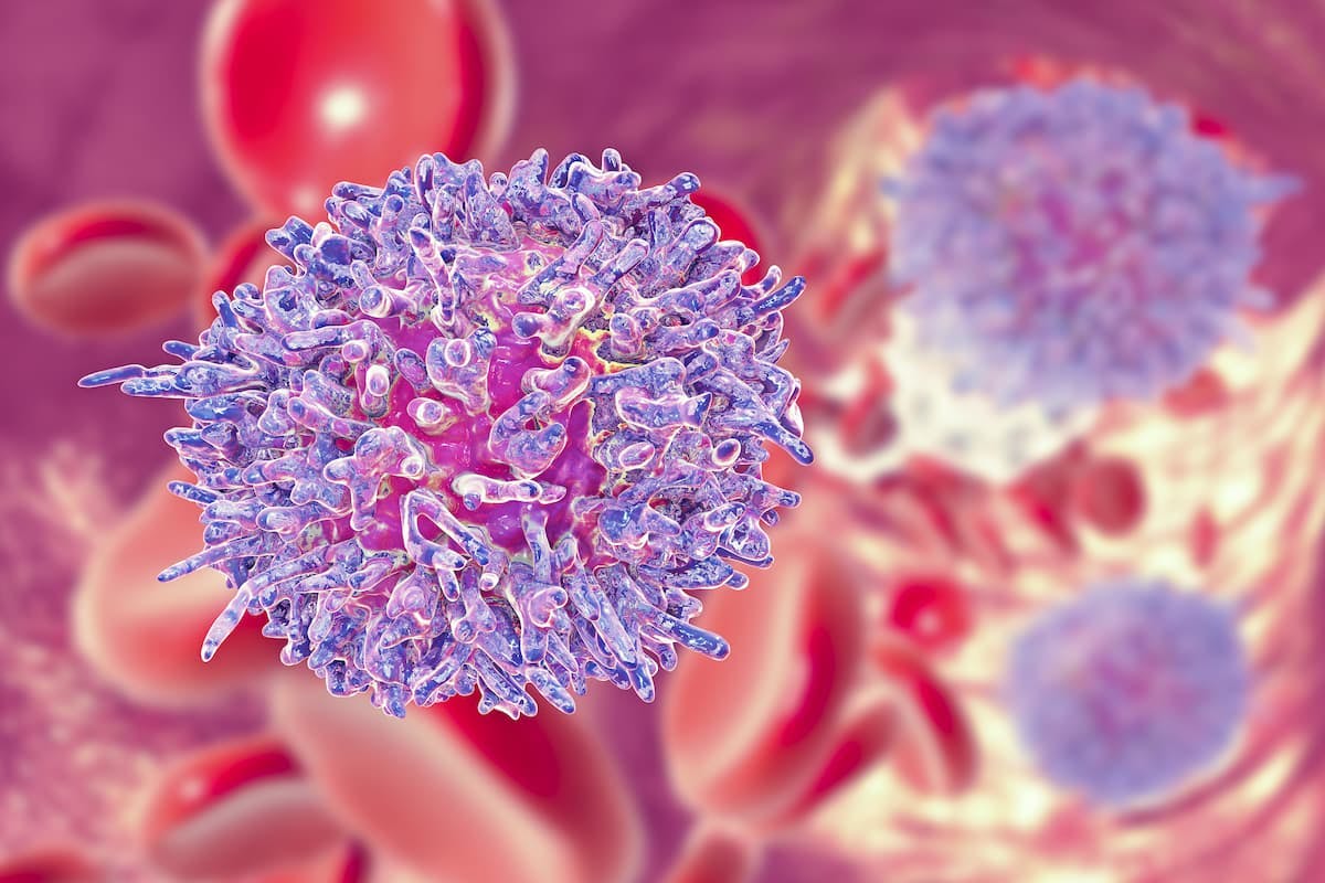 Investigators report that bendamustine/rituximab debulking appears to decrease tumor lysis syndrome risk in patients with previously untreated chronic lymphocytic leukemia.