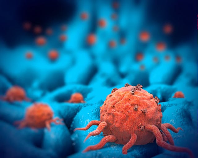 First-Line Avelumab Comparable With SOC for Bladder Cancer Subtype