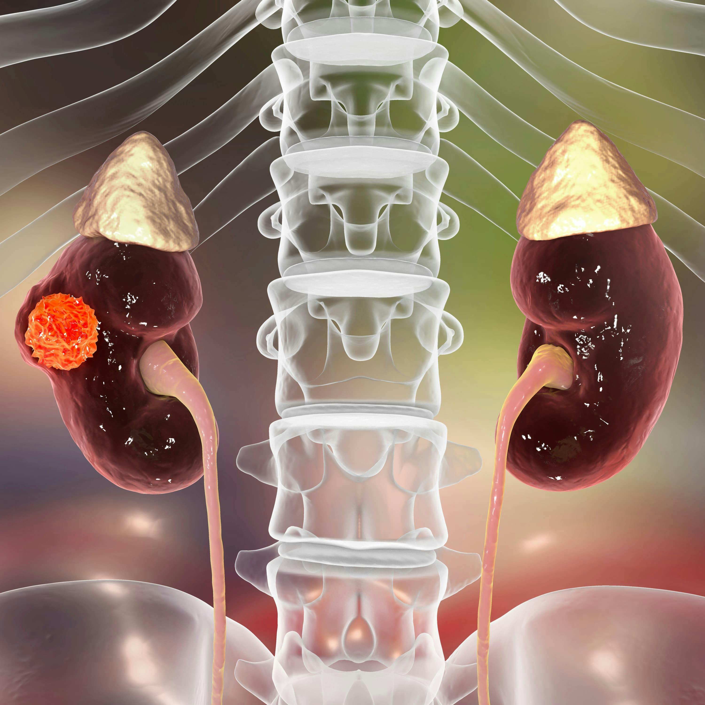 “Decreasing the extent of the IVC [inferior vena cava] thrombus and pathological downstaging with perioperative IO [immuno-oncology]–based therapies improves complexity of nephrectomy,” lead study author Damla Gunenc said.