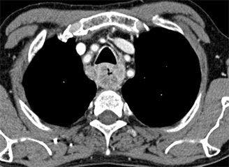 Esophageal cancer as seen on CT