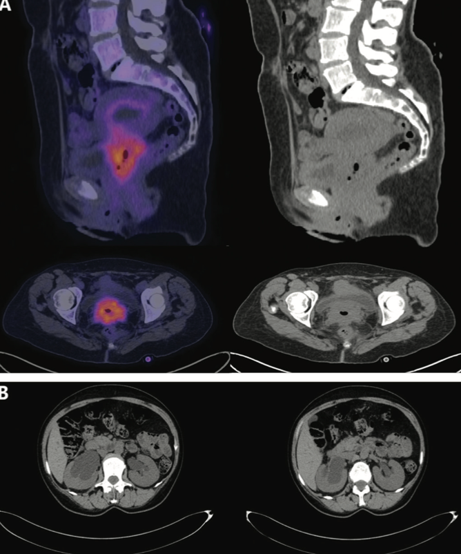 FIGURE 1. Baseline PET-CT Scan (A) Local metabolic
activity in the cervix. The lesion measured 48 x 59 mm, extending to the vagina with SUVmax of 12.2 and MTV of 36.8 cm3. Lymphadenopathy of the left external iliac chain measured 13 mm with SUVmax of 9.4 and MTV of 1.58 cm3. Left common iliac adenopathy measured 10 mm with SUVmax of 4.2 and MTV of 2.49 cm3. (B) The presence of bilateral renal ectasia is evidenced. MTV, metabolic tumor volume; SUVmax, maximum standard unit value.