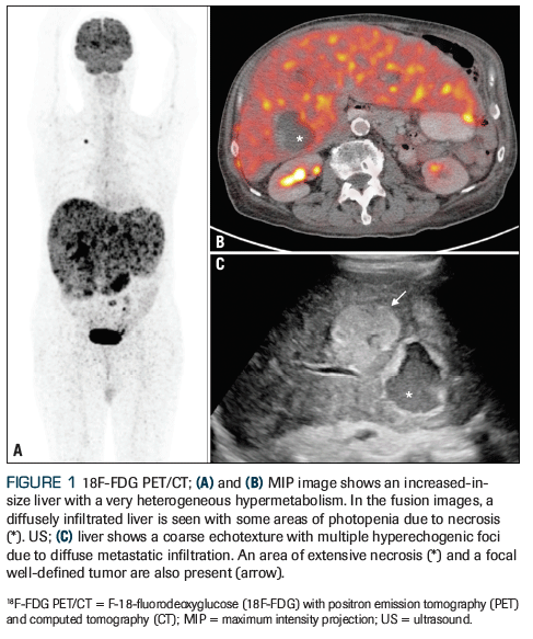 Diffuse Hepatic Infiltration by Metastatic Melanoma