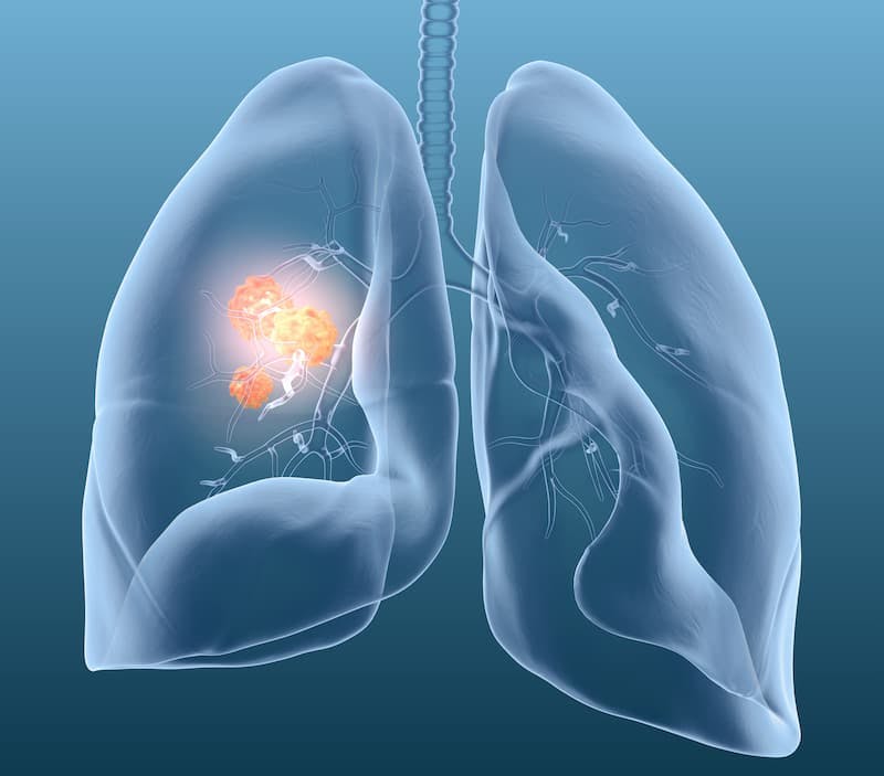 "Our results show excellent tumor control with minimal toxicity with SBRT, and this should be considered a treatment option for these patients [with lung neuroendocrine tumors]," according to an expert from Moffitt Cancer Center.