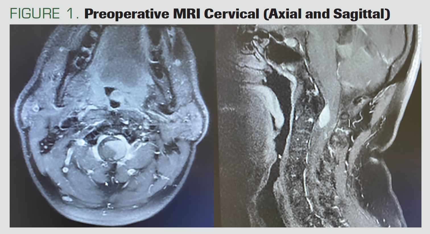 FIGURE 1. Preoperative MRI Cervical (Axial and Sagittal)