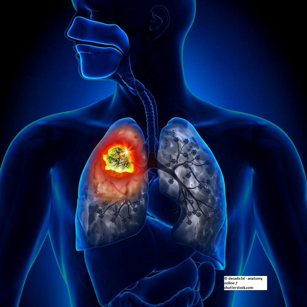 lung cancer, lung tumor