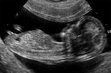 Embryo at 12 weeks
