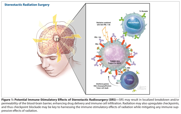 Stereotactic Radiation Therapy Combined With Immunotherapy: Augmenting the Role of Radiation in Local and Systemic Treatment 
