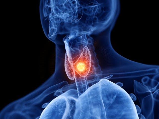 Pembrolizumab also appears to garner modest anti-tumor activity regardless of PD-L1 expression in patients with advanced thyroid cancer.