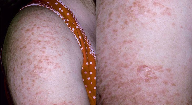 A 28-Year-Old Woman Presents With a Long-Standing History of Intermittently Painful “Bumps” on Both Her Shoulders and Upper Back