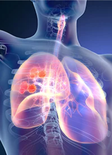 Patients with stage II to IIIA non–small cell lung cancer experienced an improvement in disease-free survival and time to locoregional and distant relapse after being treated with adjuvant atezolizumab.