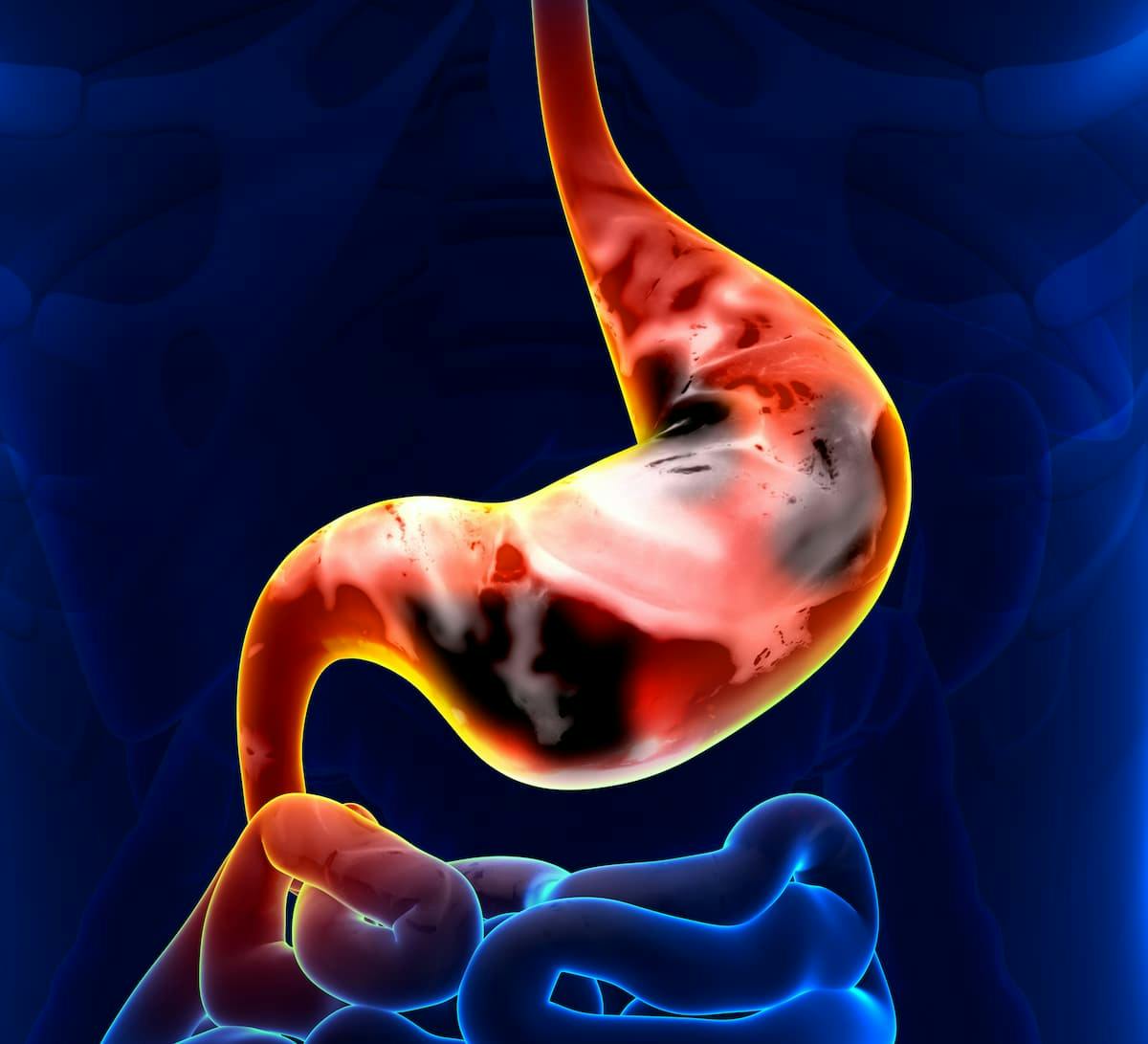 CMG901 demonstrated a well-tolerated safety profile in patients with CLDN18.2-positive, advanced gastric/gastroesophageal junction cancer. 
