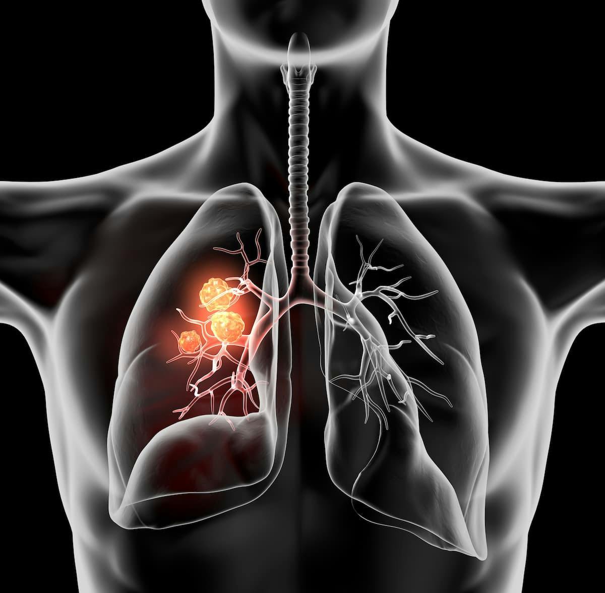 Factors including age, gender, and facility type may influence the likelihood of pain referrals for lung cancer, suggesting a need for multidisciplinary pain management in this patient population.