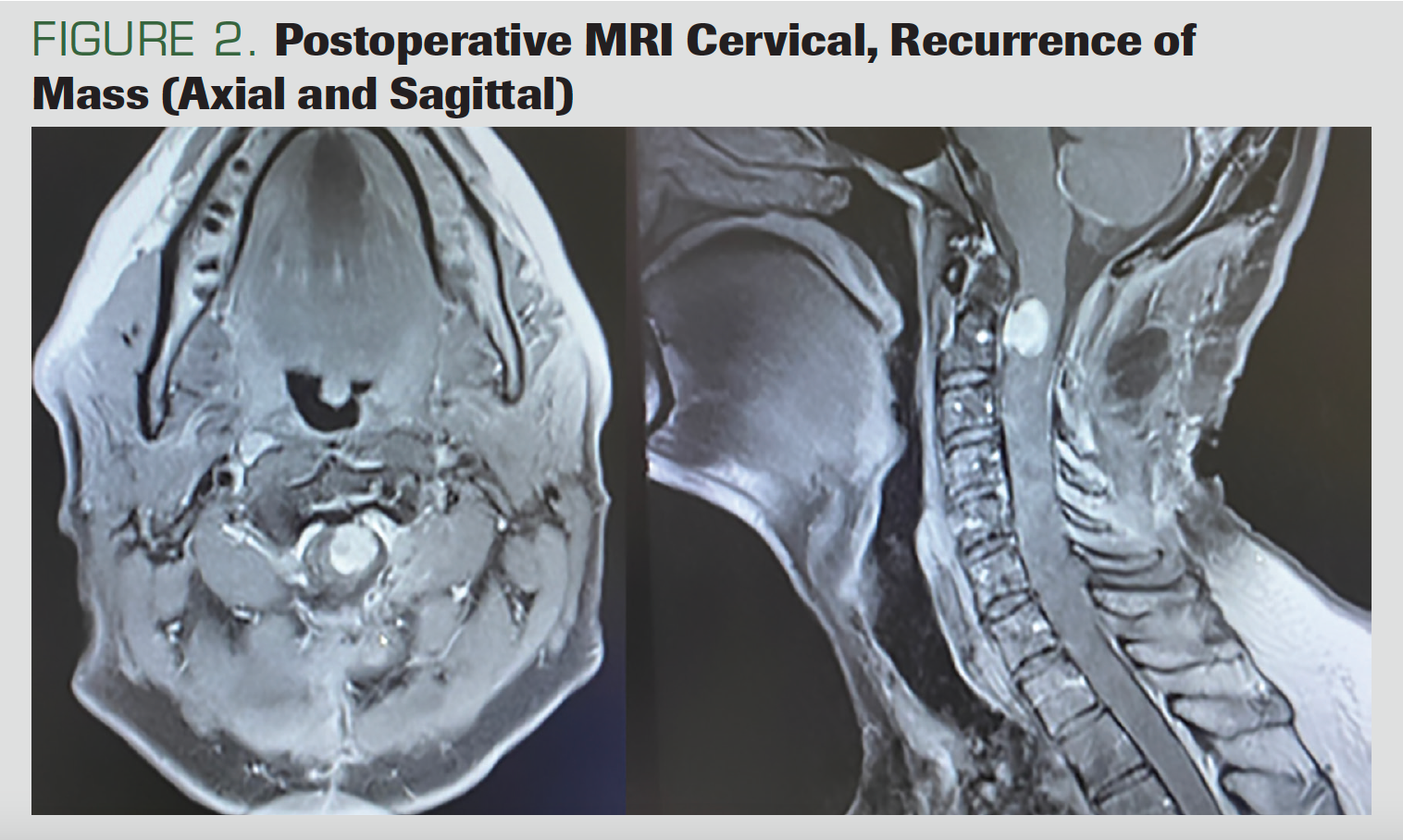 FIGURE 2. Postoperative MRI Cervical, Recurrence of Mass (Axial and Sagittal)