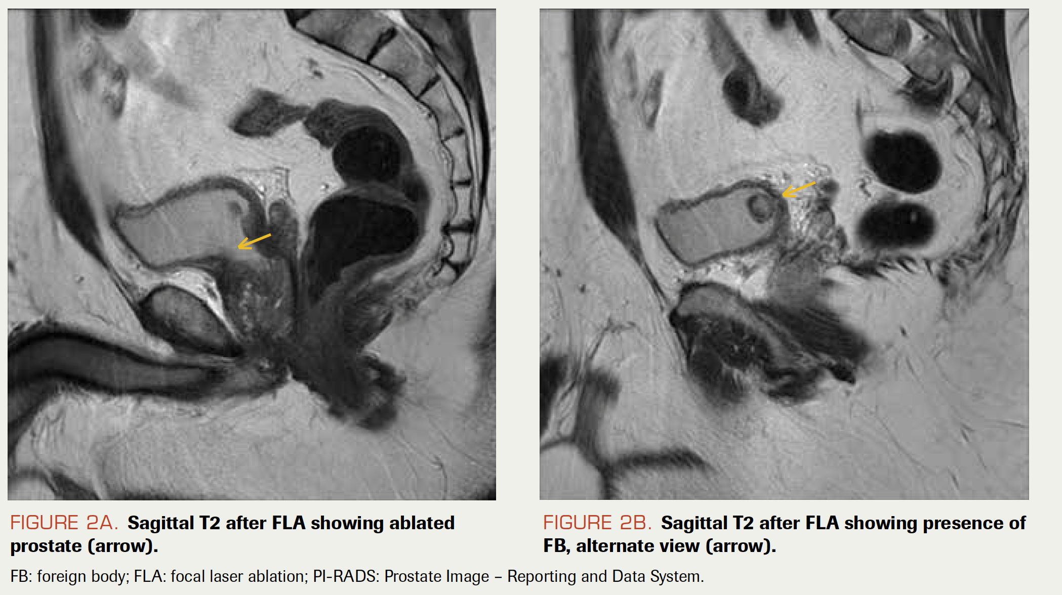 FIGURE 2A. Sagittal T2 after FLA showing ablated prostate (arrow).

FIGURE 2B. Sagittal T2 after FLA showing presence of FB, alternate view (arrow).

FB: foreign body; FLA: focal laser ablation; PI-RADS: Prostate Image – Reporting and Data System.