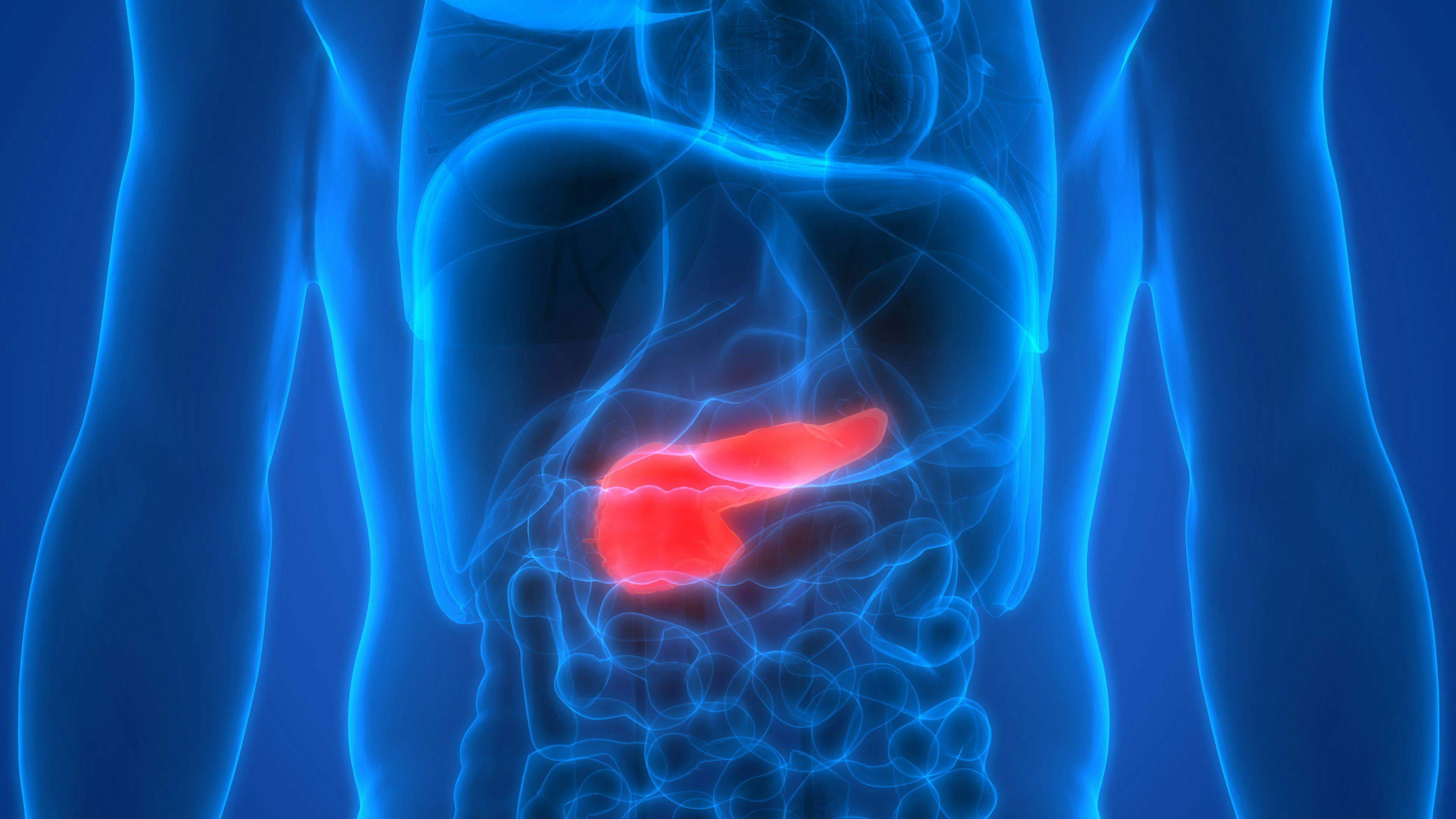 Diane Simeone, MD, spoke to the need to determine which patients are at risk of developing pancreatic cancer, the importance of early detection, and challenges that need to be addressed in order to improve survival.