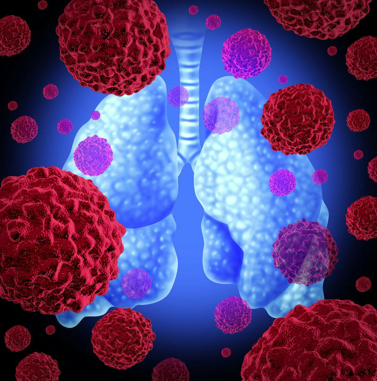 SBRT Regimen Improves PFS in Oligoprogressive Non–Small Cell Lung Cancer