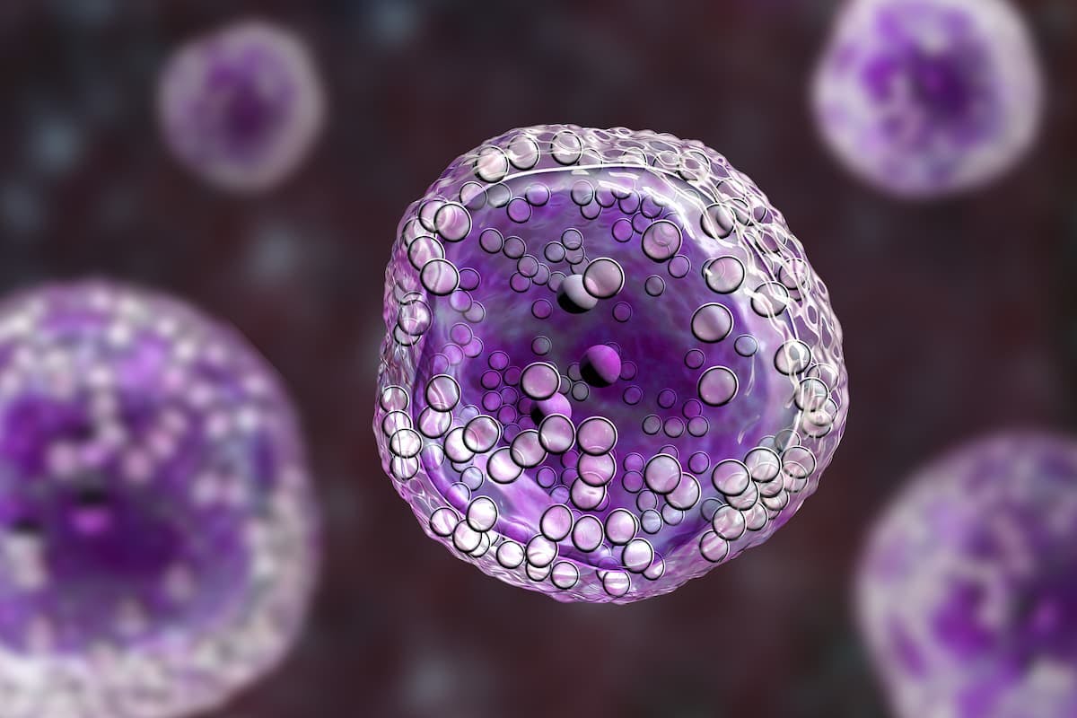 The European Commission based its approval of axicabtagene ciloleucel as a second-line therapy for patients with relapsed/refractory diffuse large B-cell lymphoma or high-grade B-cell lymphoma on the efficacy findings of the phase 3 ZUMA-7 trial.