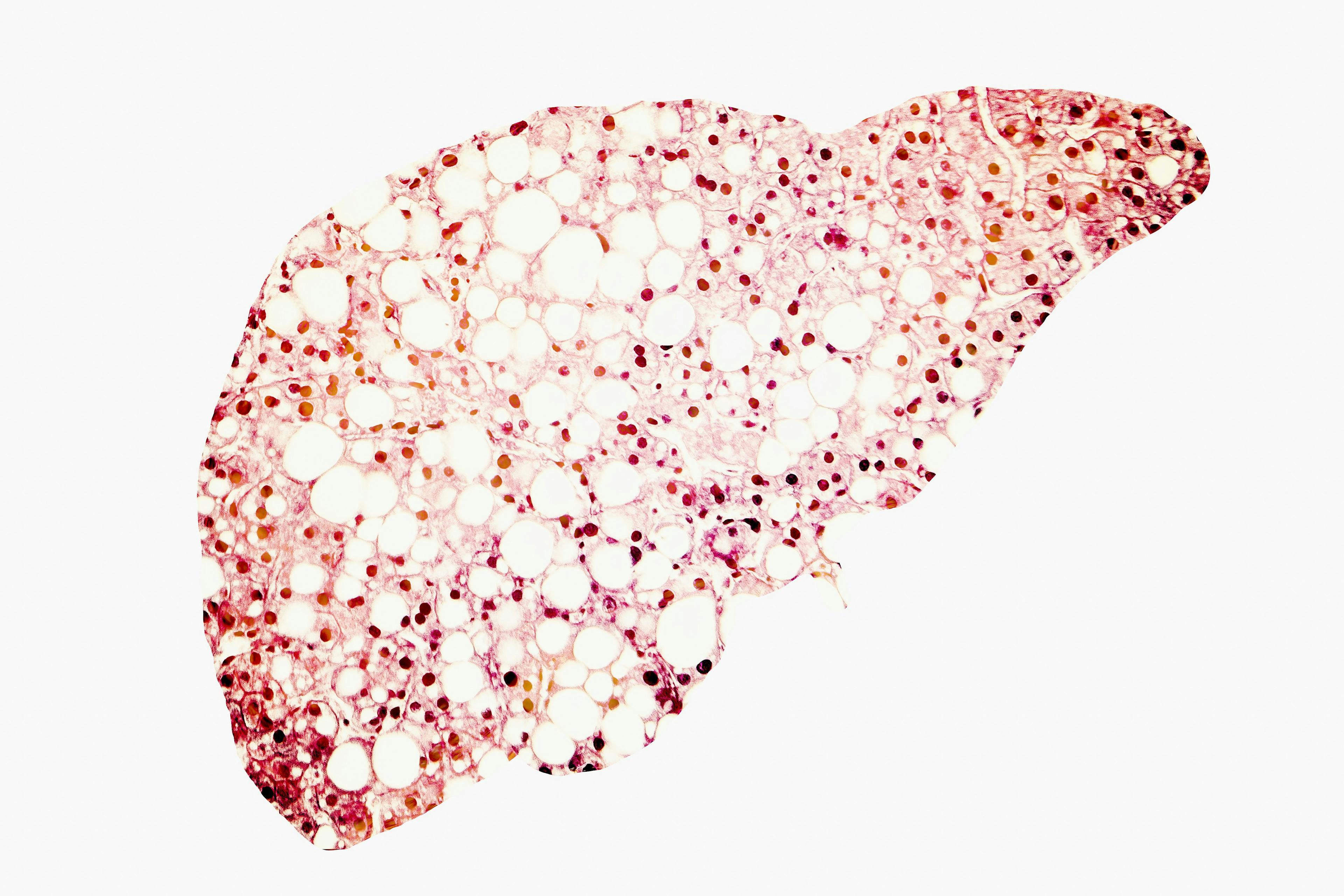 Patients with advanced hepatocellular carcinoma who received prior treatment with sorafenib appear to benefit from treatment with pembrolizumab and best supportive care.