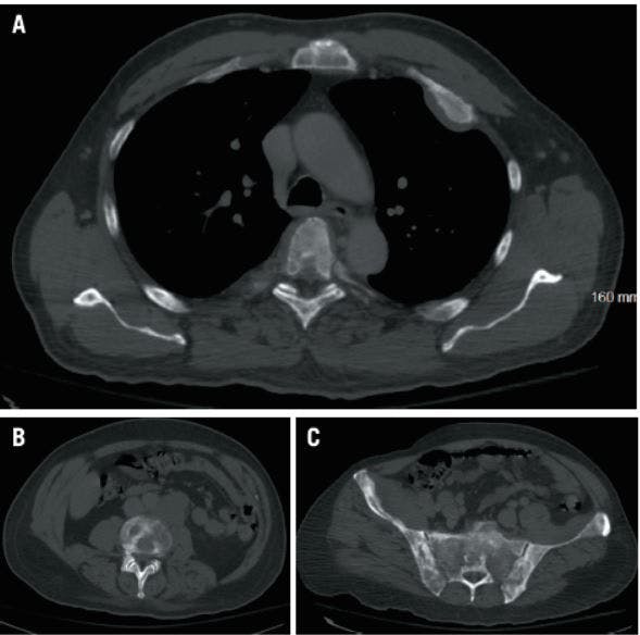 Pathologic Hip Fracture in a 49-Year-Old Man With Widespread Metastatic Sclerotic Bone Lesions