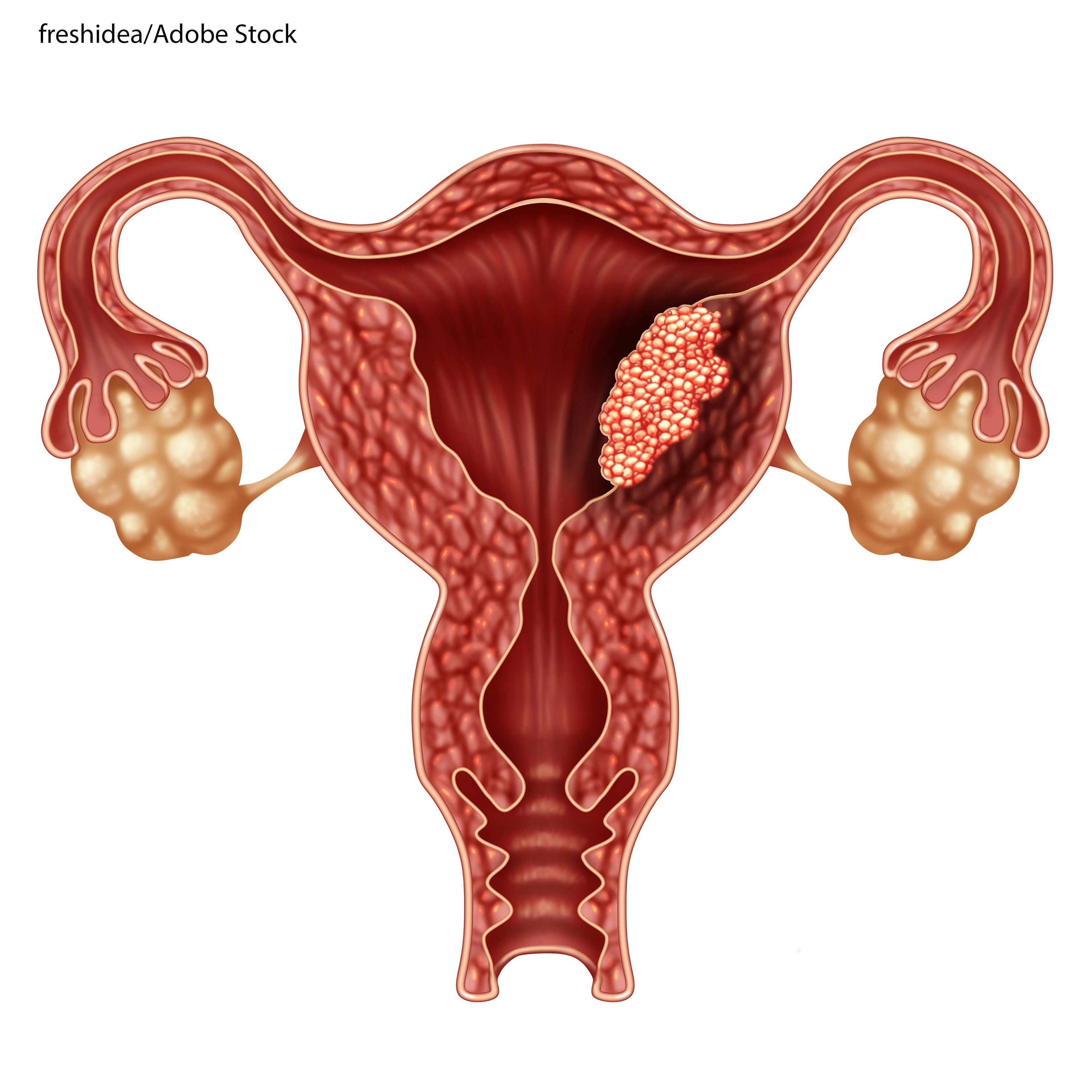 Early Chemo Does Not Improve Survival in Endometrial Cancer