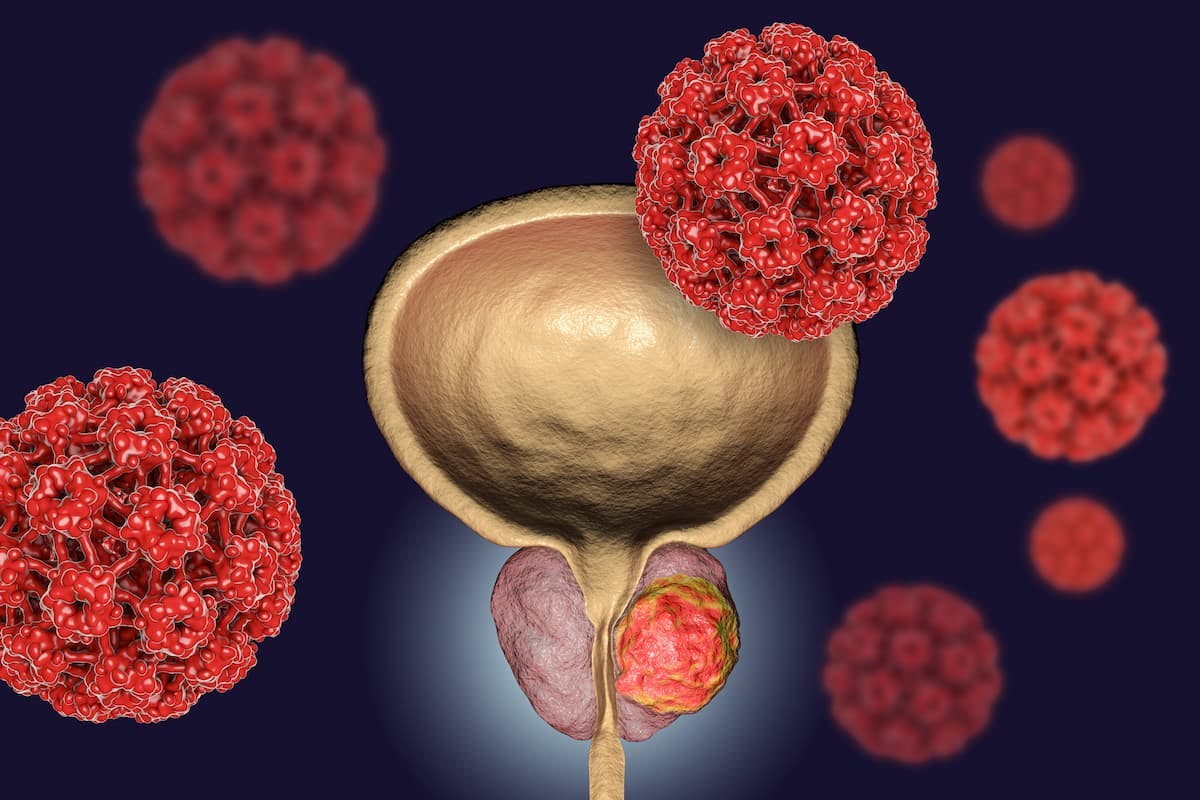 The appearance of circulating tumor DNA and androgen receptor aberrations yielded lower overall survival rates for patients with metastatic castration-sensitive prostate cancer during the phase 3 TITAN trial, according to Agarwal, MD.