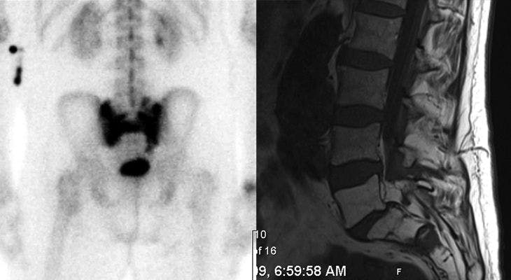 Lower Back Pain in an Elderly Man With a History of Localized Prostate Cancer