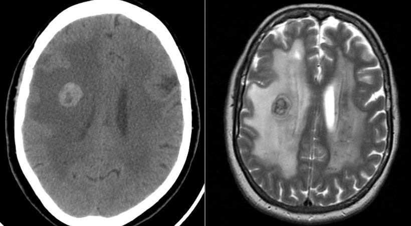 A Patient With Intermittent Headaches and Visual Changes
