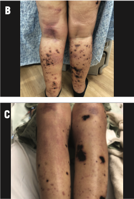(B) Clinical examination after 1 week of prednisone treatment, showing persistent vesiculation and ulceration but no new lesions.
(C) Clinical examination 1 month after treatment showing improvement in ulcerations.
