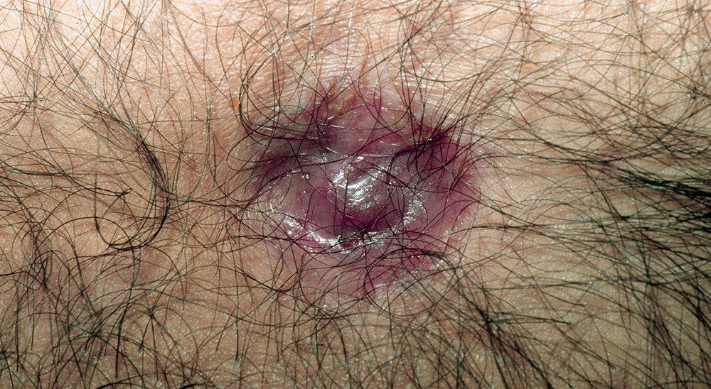 A 74-Year-Old Caucasian Man Presents With Asymptomatic Navel “Lump”