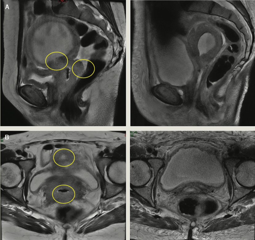 FIGURE 2. Response Assessment Imaging (A) Pelvic MRI image (sagittal section, without contrast). The image on the left corresponds to the baseline diagnosis; the image on the right corresponds to the response assessment 8 weeks after treatment completion. (B) Pelvic MRI image (axial section, without contrast). The image on the left corresponds to the baseline diagnosis; the image on the right corresponds to the response assessment 8 weeks after treatment completion.