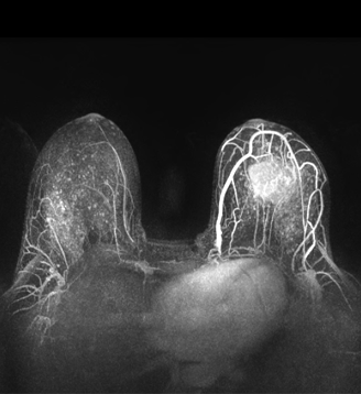 MRI of invasive breast cancer
