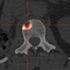 Bone Metastases Result in Worse Outcomes for RCC Patients