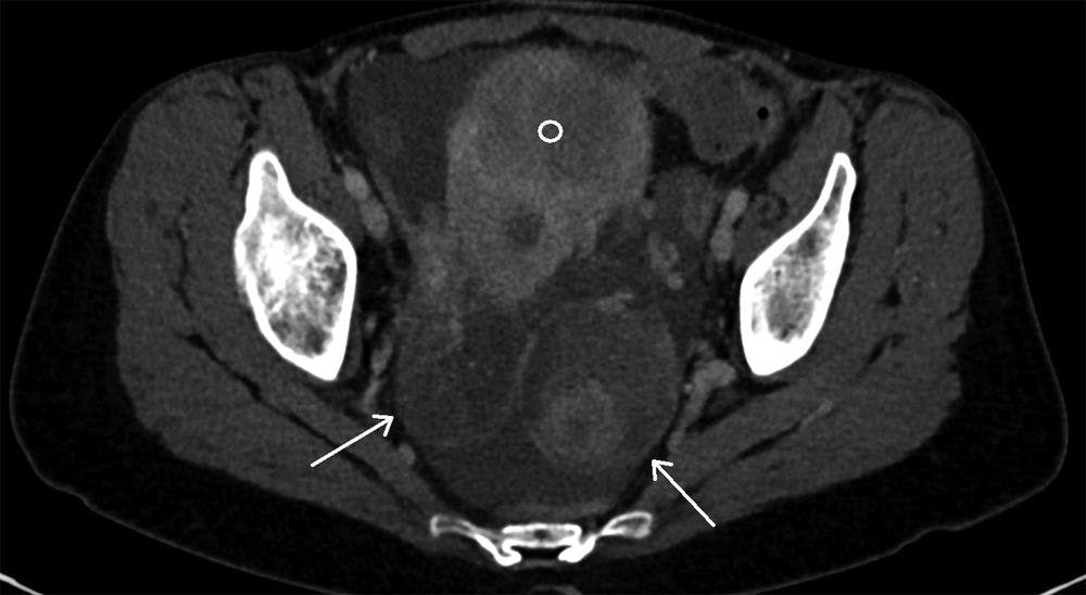 Staging CT Abnormality in Gastric Cancer Patient