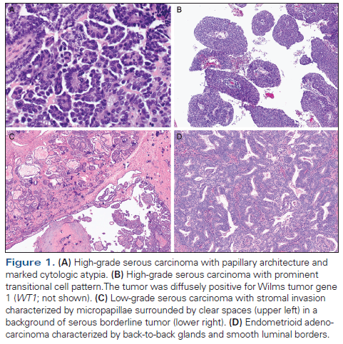 Morphologic, Immunophenotypic, and Molecular Features of Epithelial Ovarian Cancer