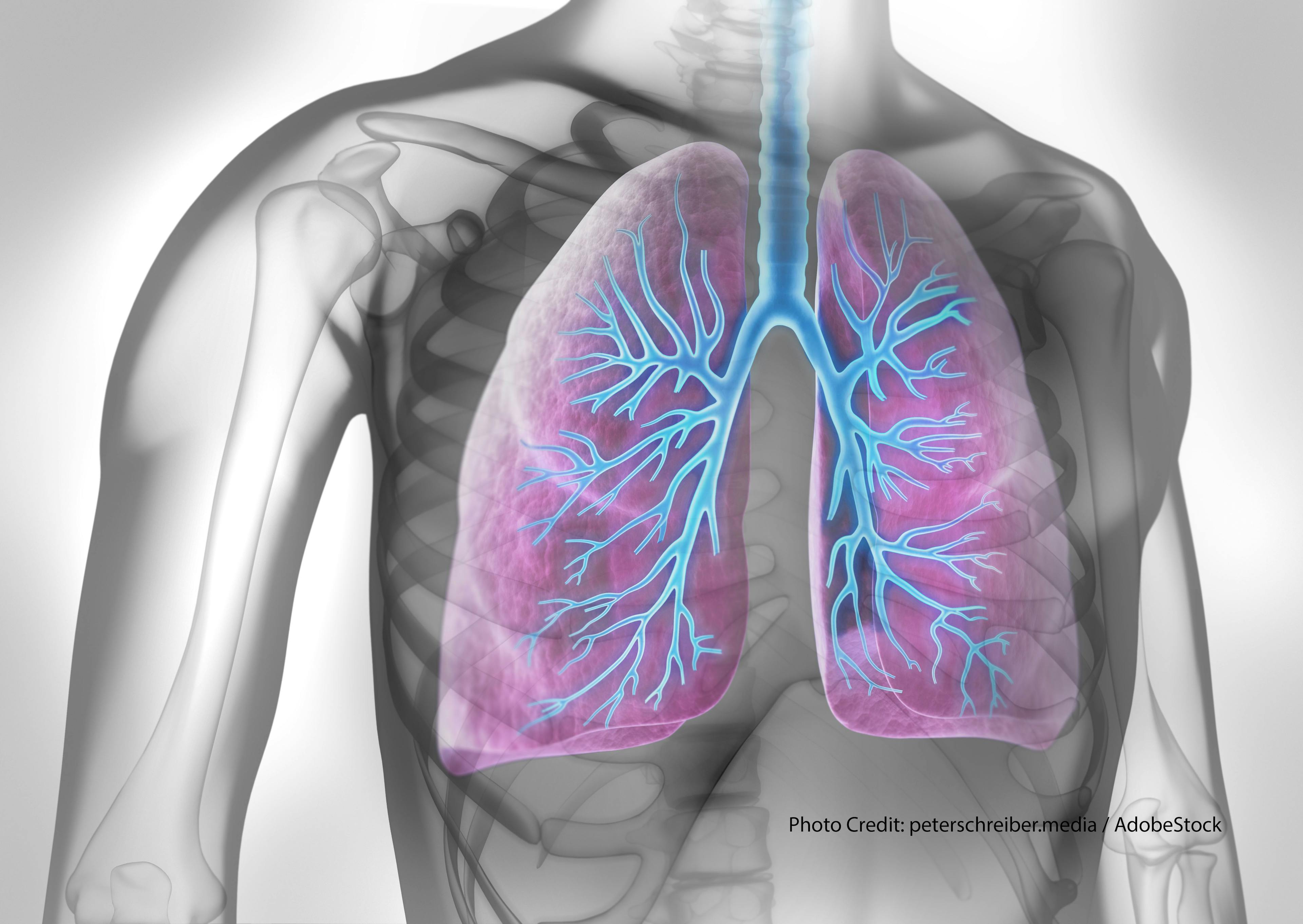 Chemotherapy in NSCLC Patients With COPD: Do Benefits Outweigh the Risks?