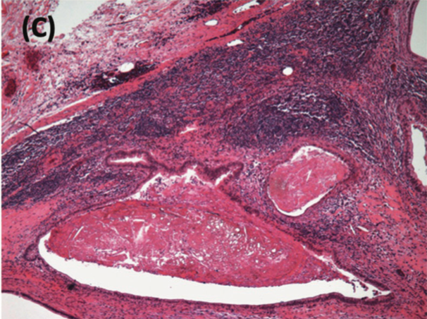 (C) H-E (Hematoxylin-eosin) stain from retroperitoneal lymph nodes showing numerous deposits of multicystic mature teratomas. The neoplasm is composed of cystic area lined by columnar and cuboidal epithelium, and other areas lined with squamous epithelium and keratinization, as well as focal mature cartilaginous tissue and fat.